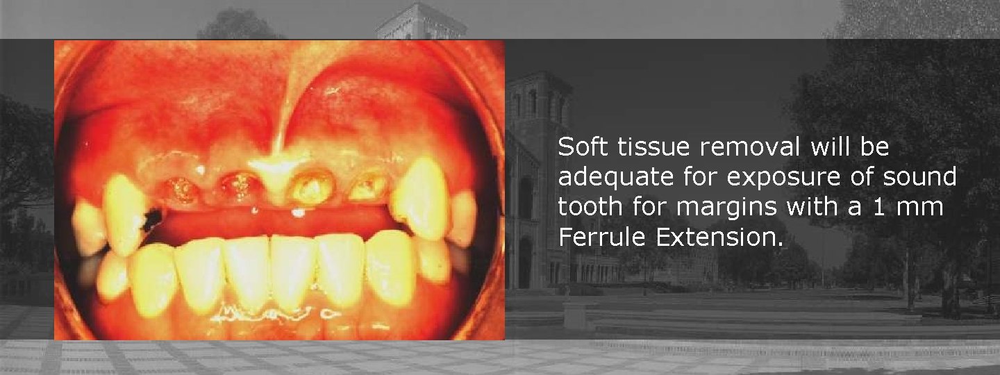 Soft tissue removal will be adequate for exposure of sound tooth for margins with