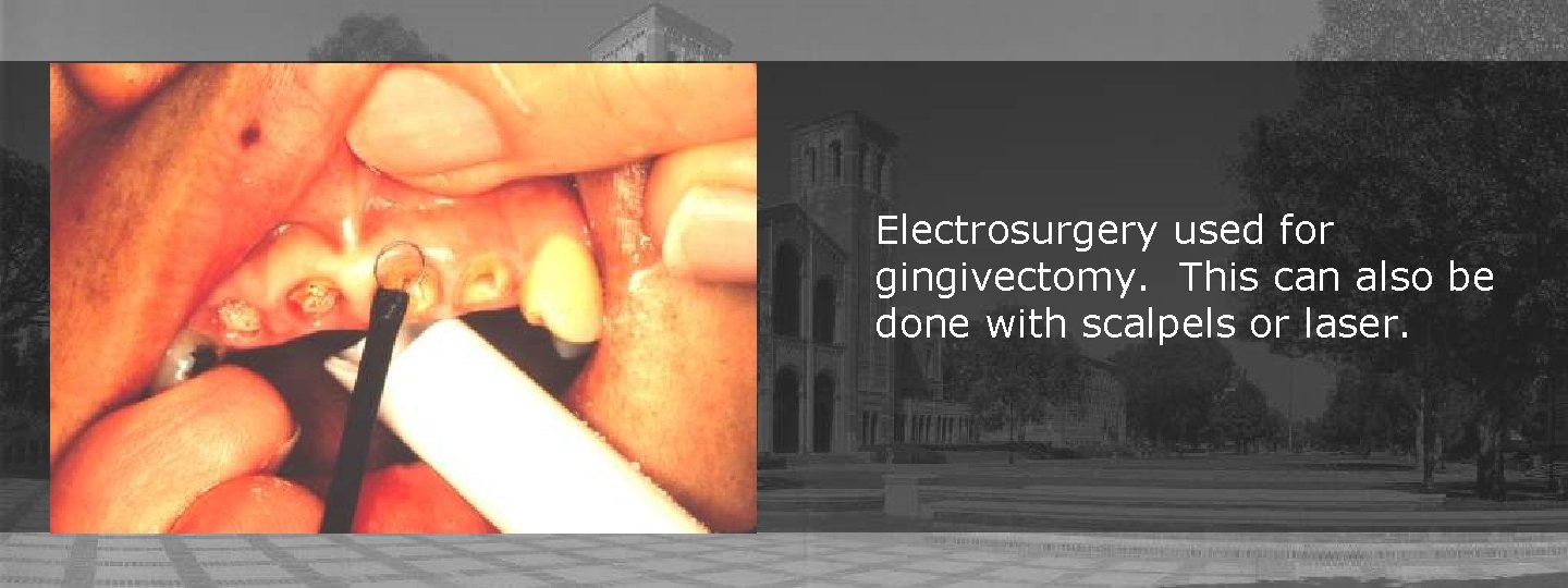 Electrosurgery used for gingivectomy. This can also be done with scalpels or laser. 