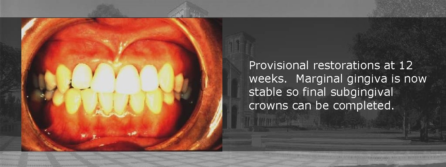 Provisional restorations at 12 weeks. Marginal gingiva is now stable so final subgingival crowns Provisional restorations at 12 weeks. Marginal gingiva is now stable so final subgingival crowns