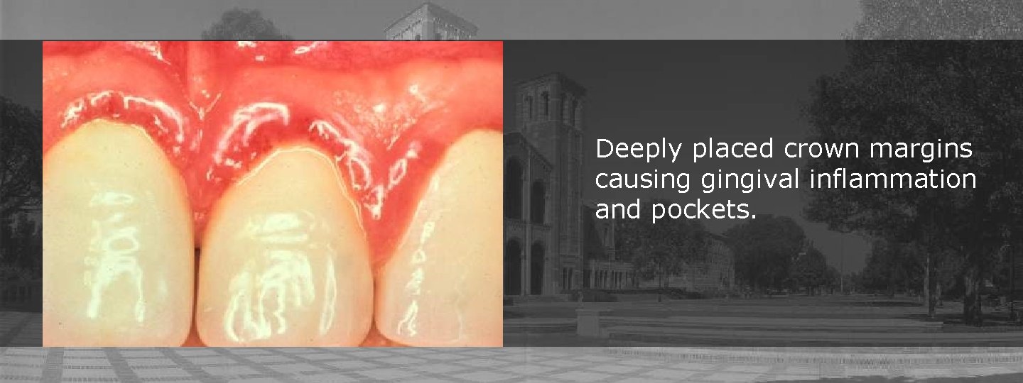 Deeply placed crown margins causing gingival inflammation and pockets. 