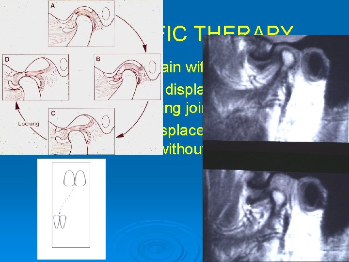 SPECIFIC THERAPY Ø 1. Myofascial pain with/without limitation Ø 2. Anterior disc displacement with