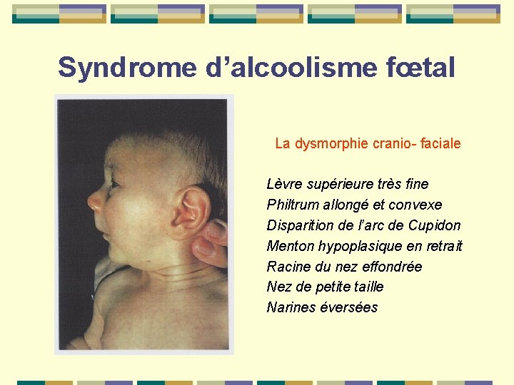 Syndrome d’alcoolisme fœtal La dysmorphie cranio- faciale Lèvre supérieure très fine Philtrum allongé et