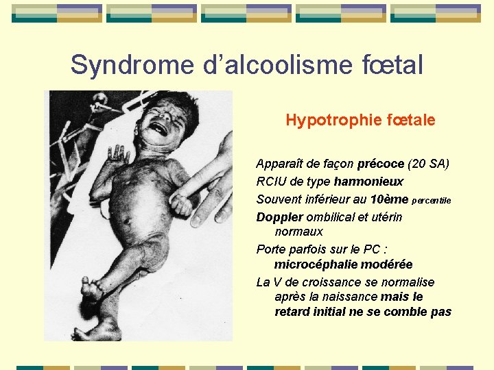 Syndrome d’alcoolisme fœtal Hypotrophie fœtale Apparaît de façon précoce (20 SA) RCIU de type