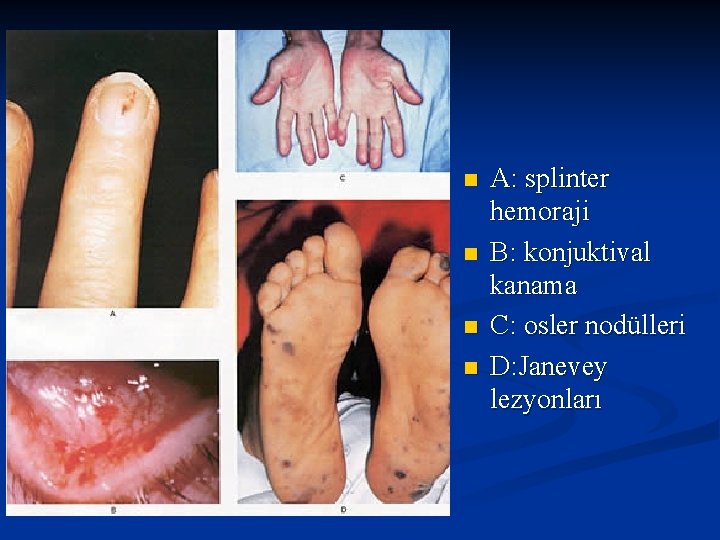 n n A: splinter hemoraji B: konjuktival kanama C: osler nodülleri D: Janevey lezyonları