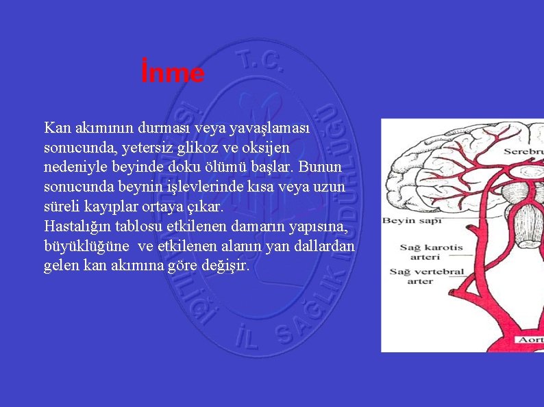 İnme 41 Kan akımının durması veya yavaşlaması sonucunda, yetersiz glikoz ve oksijen nedeniyle beyinde