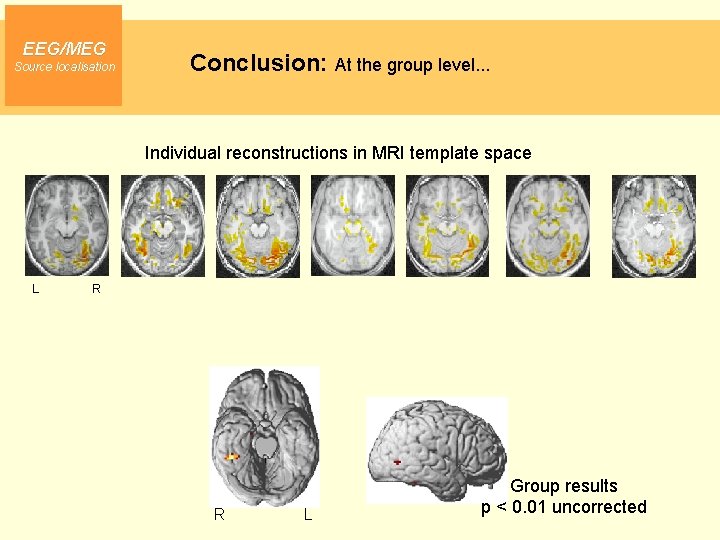 EEG/MEG Source localisation Conclusion: At the group level. . . Individual reconstructions in MRI