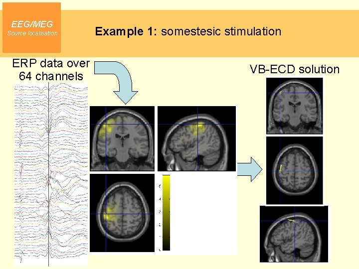 EEG/MEG Source localisation Example 1: somestesic stimulation ERP data over 64 channels VB-ECD solution