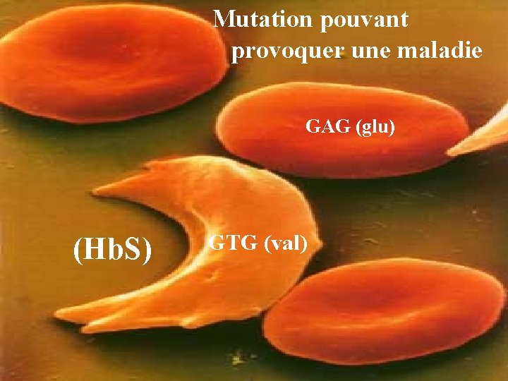 Mutation pouvant provoquer une maladie GAG (glu) (Hb. S) GTG (val) Mutation pouvant provoquer une maladie GAG (glu) (Hb. S) GTG (val)