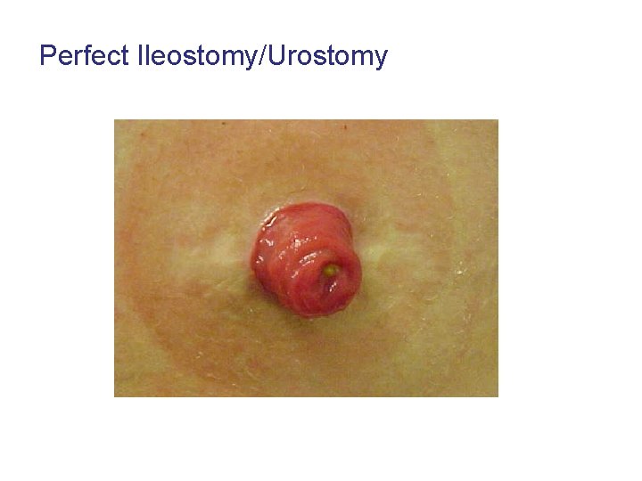 Perfect Ileostomy/Urostomy 