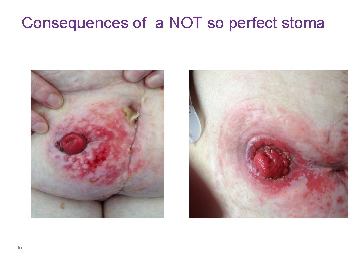 Consequences of a NOT so perfect stoma 15 
