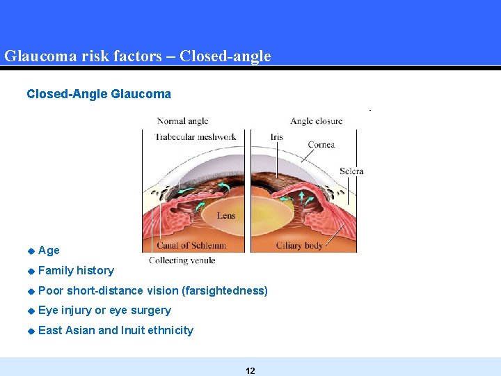 Glaucoma risk factors – Closed-angle Closed-Angle Glaucoma u Age u Family history u Poor Glaucoma risk factors – Closed-angle Closed-Angle Glaucoma u Age u Family history u Poor