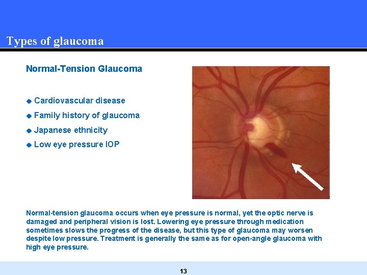 Types of glaucoma Normal-Tension Glaucoma u Cardiovascular disease u Family history of glaucoma u Types of glaucoma Normal-Tension Glaucoma u Cardiovascular disease u Family history of glaucoma u