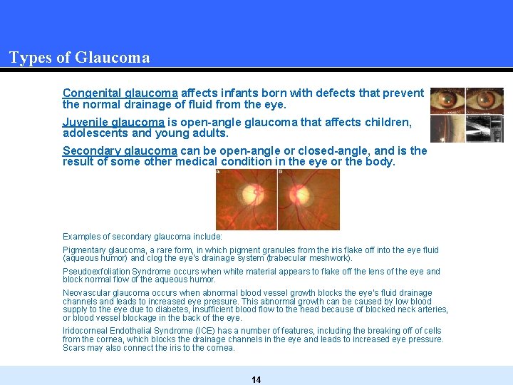 Types of Glaucoma Congenital glaucoma affects infants born with defects that prevent the normal Types of Glaucoma Congenital glaucoma affects infants born with defects that prevent the normal