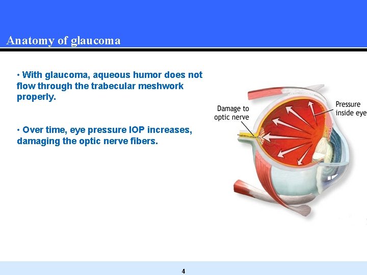 Anatomy of glaucoma • With glaucoma, aqueous humor does not flow through the trabecular Anatomy of glaucoma • With glaucoma, aqueous humor does not flow through the trabecular