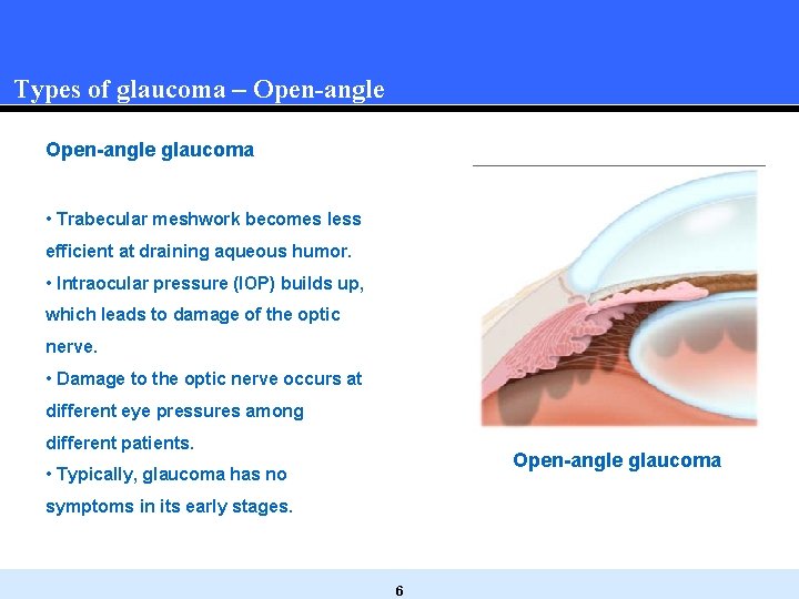 Types of glaucoma – Open-angle glaucoma • Trabecular meshwork becomes less efficient at draining Types of glaucoma – Open-angle glaucoma • Trabecular meshwork becomes less efficient at draining