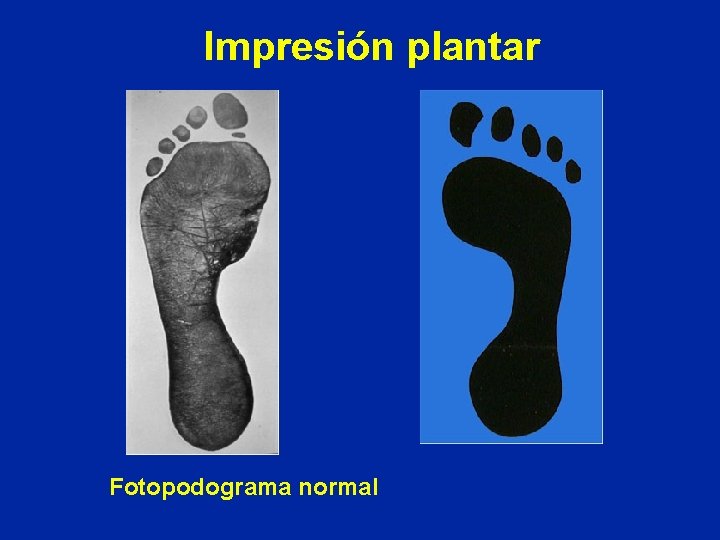Impresión plantar Fotopodograma normal 