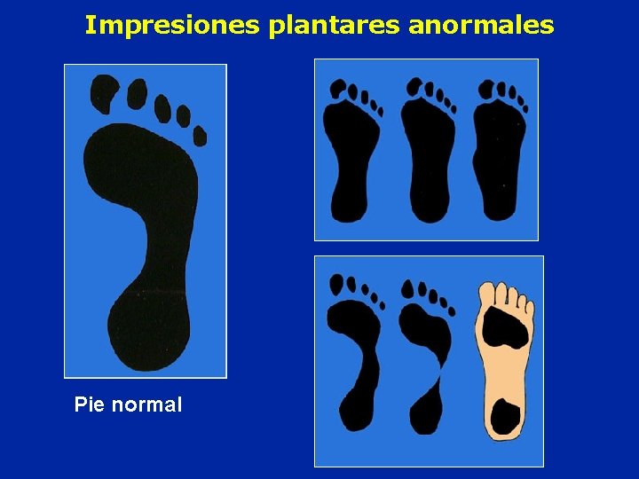 Impresiones plantares anormales Pie normal 