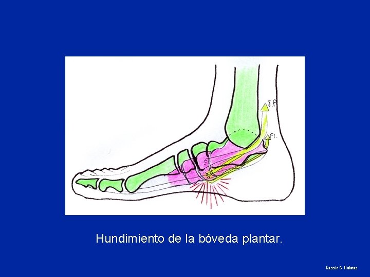 Hundimiento de la bóveda plantar. Dessin G Halatas 