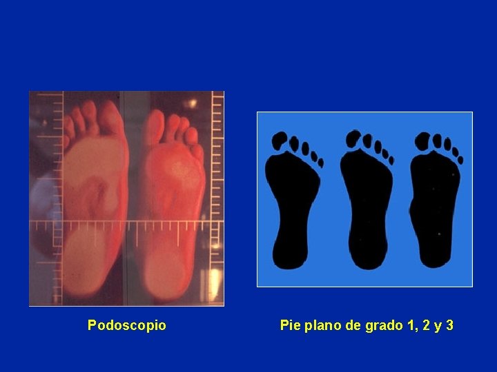 Podoscopio Pie plano de grado 1, 2 y 3 