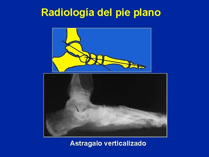 Radiología del pie plano Astragalo verticalizado 