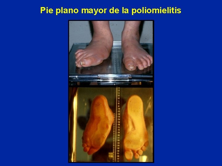 Pie plano mayor de la poliomielitis 