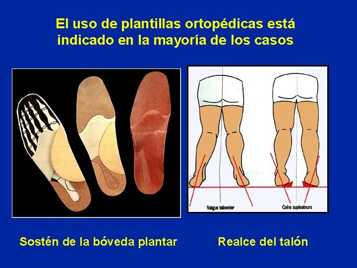 El uso de plantillas ortopédicas está indicado en la mayoría de los casos Sostén