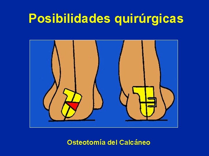 Posibilidades quirúrgicas Osteotomía del Calcáneo 