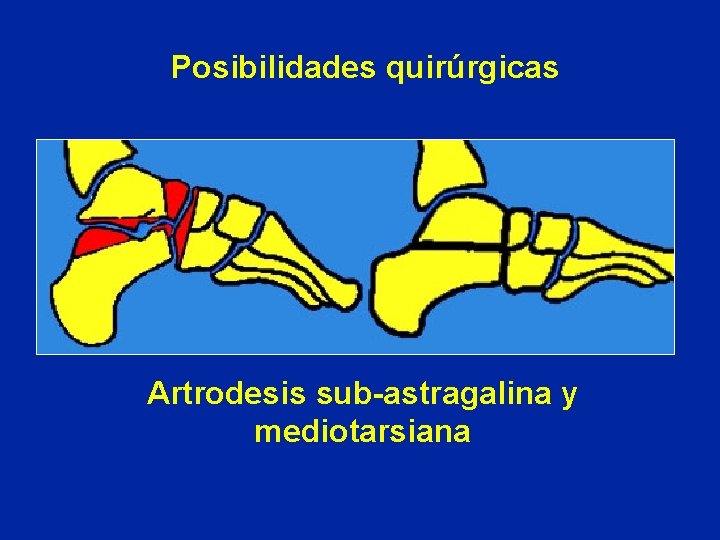 Posibilidades quirúrgicas Artrodesis sub-astragalina y mediotarsiana 