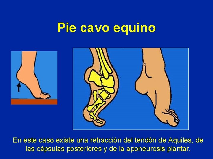 Pie cavo equino En este caso existe una retracción del tendón de Aquiles, de