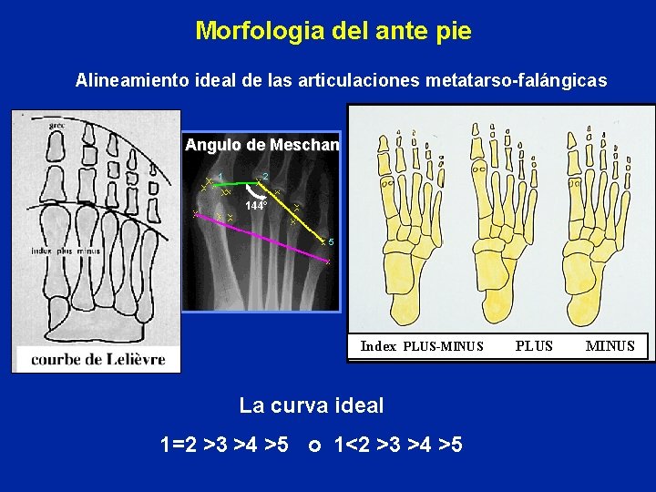 Morfologia del ante pie Alineamiento ideal de las articulaciones metatarso-falángicas Angulo de Meschan 1
