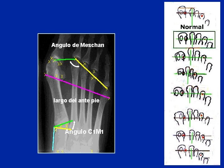Angulo de Meschan largo del ante pie Angulo C 1 M 1 