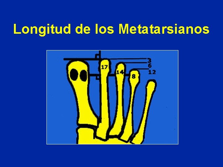 Longitud de los Metatarsianos 