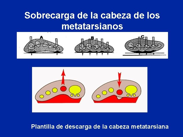 Sobrecarga de la cabeza de los metatarsianos Plantilla de descarga de la cabeza metatarsiana