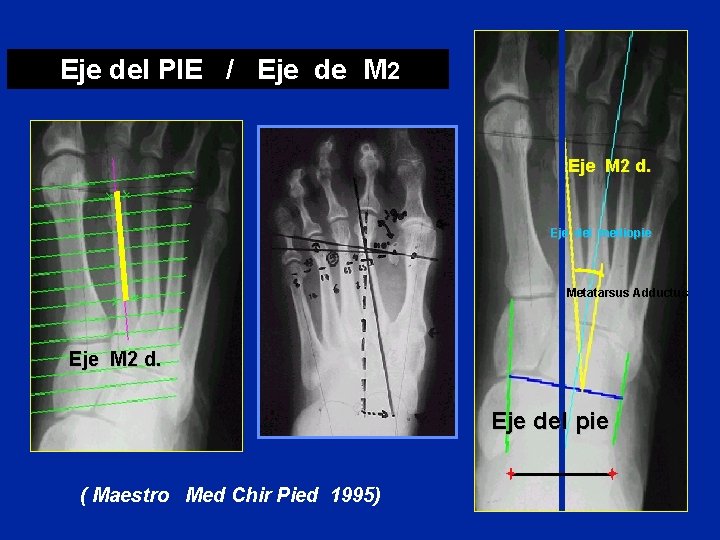 Eje del PIE / Eje de M 2 Eje M 2 d. Eje del