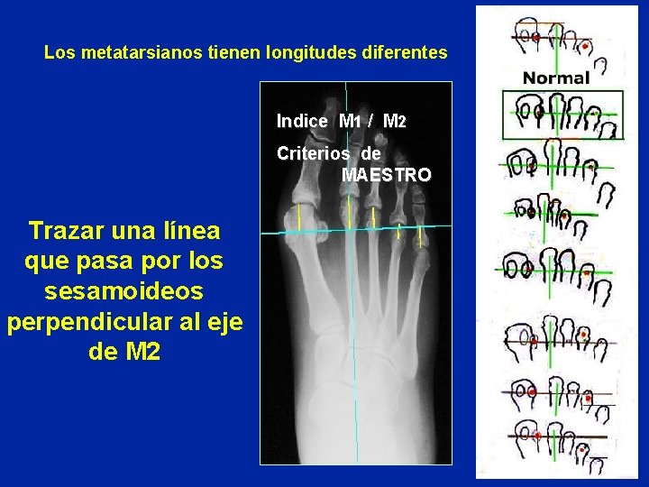 Los metatarsianos tienen longitudes diferentes Indice M 1 / M 2 Criterios de MAESTRO