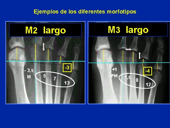 Ejemplos de los diferentes morfotipos M 2 largo - 3, 5 M -3 5