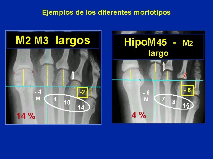 Ejemplos de los diferentes morfotipos M 2 M 3 largos Hipo. M 45 -