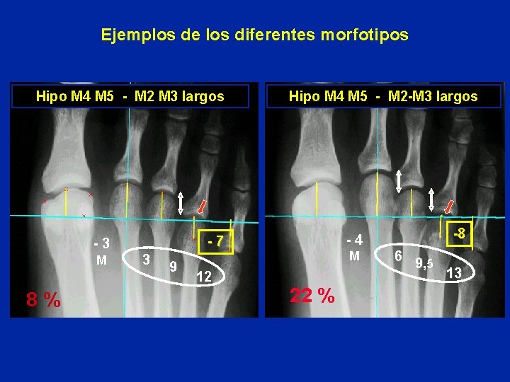 Ejemplos de los diferentes morfotipos Hipo M 4 M 5 - M 2 M