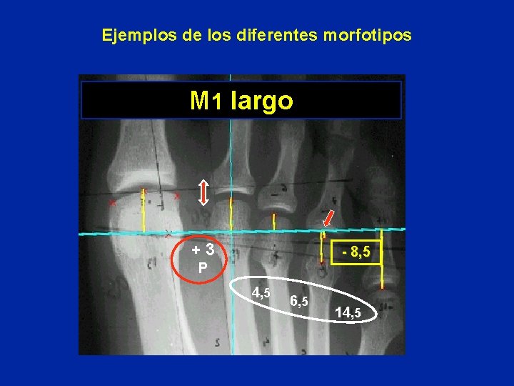 Ejemplos de los diferentes morfotipos M 1 largo +3 - 8, 5 P 4,