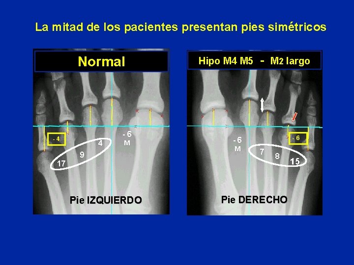 La mitad de los pacientes presentan pies simétricos Normal -4 17 4 -6 M