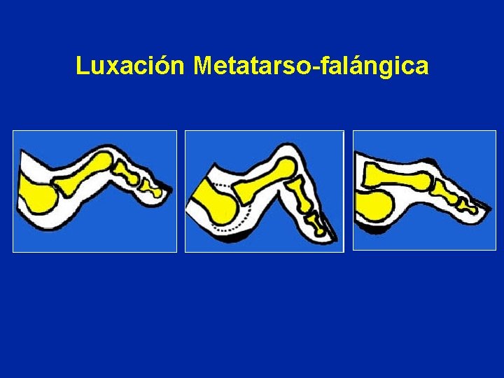 Luxación Metatarso-falángica 