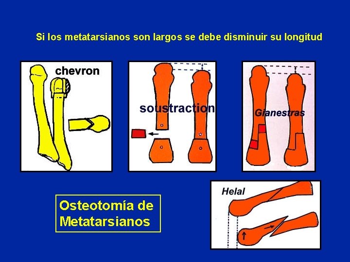 Si los metatarsianos son largos se debe disminuir su longitud Osteotomía de Metatarsianos 