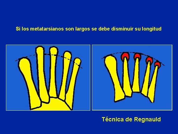 Si los metatarsianos son largos se debe disminuir su longitud Técnica de Regnauld 