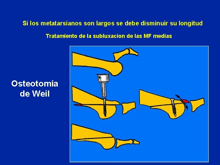 Si los metatarsianos son largos se debe disminuir su longitud Tratamiento de la subluxacion