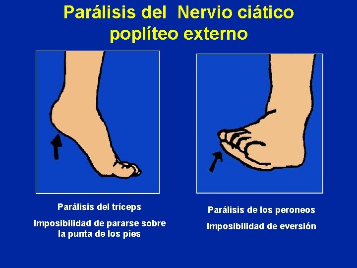 Parálisis del Nervio ciático poplíteo externo Parálisis del tríceps Parálisis de los peroneos Imposibilidad