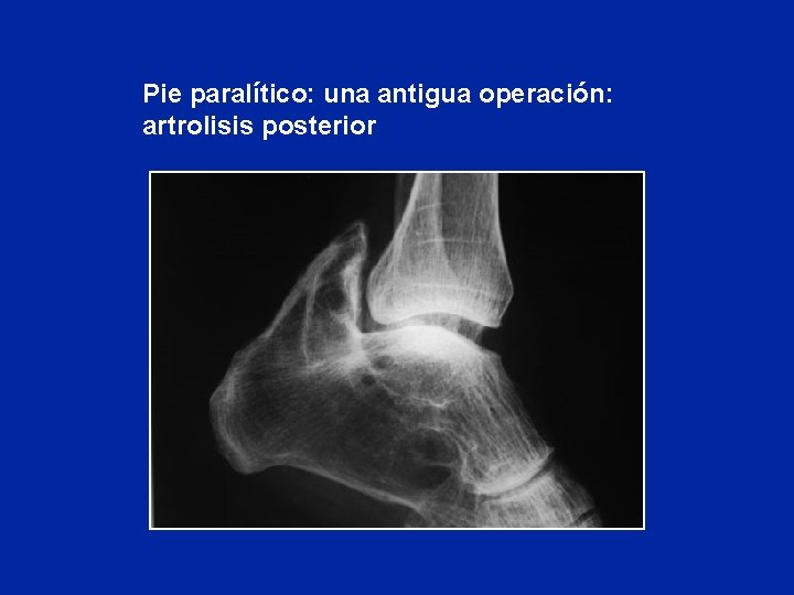 Pie paralítico: una antigua operación: artrolisis posterior 