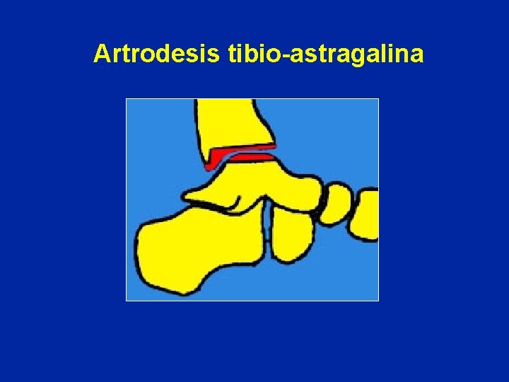 Artrodesis tibio-astragalina 