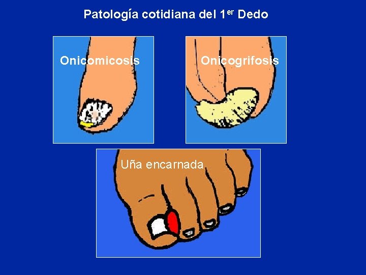 Patología cotidiana del 1 er Dedo Onicomicosis Onicogrifosis Uña encarnada 