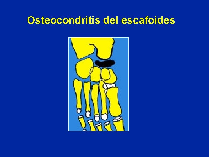 Osteocondritis del escafoides 