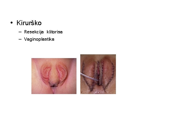  • Kirurško – Resekcija klitorisa – Vaginoplastika 